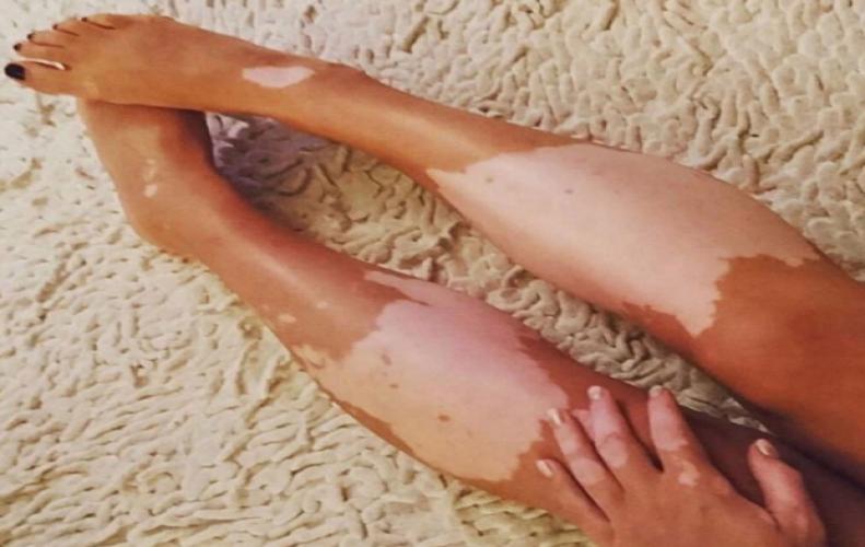 What's Causing White Spots On Legs And How Can I Treat Them? What's Causing White Spots On Legs And How Can I Treat Them?